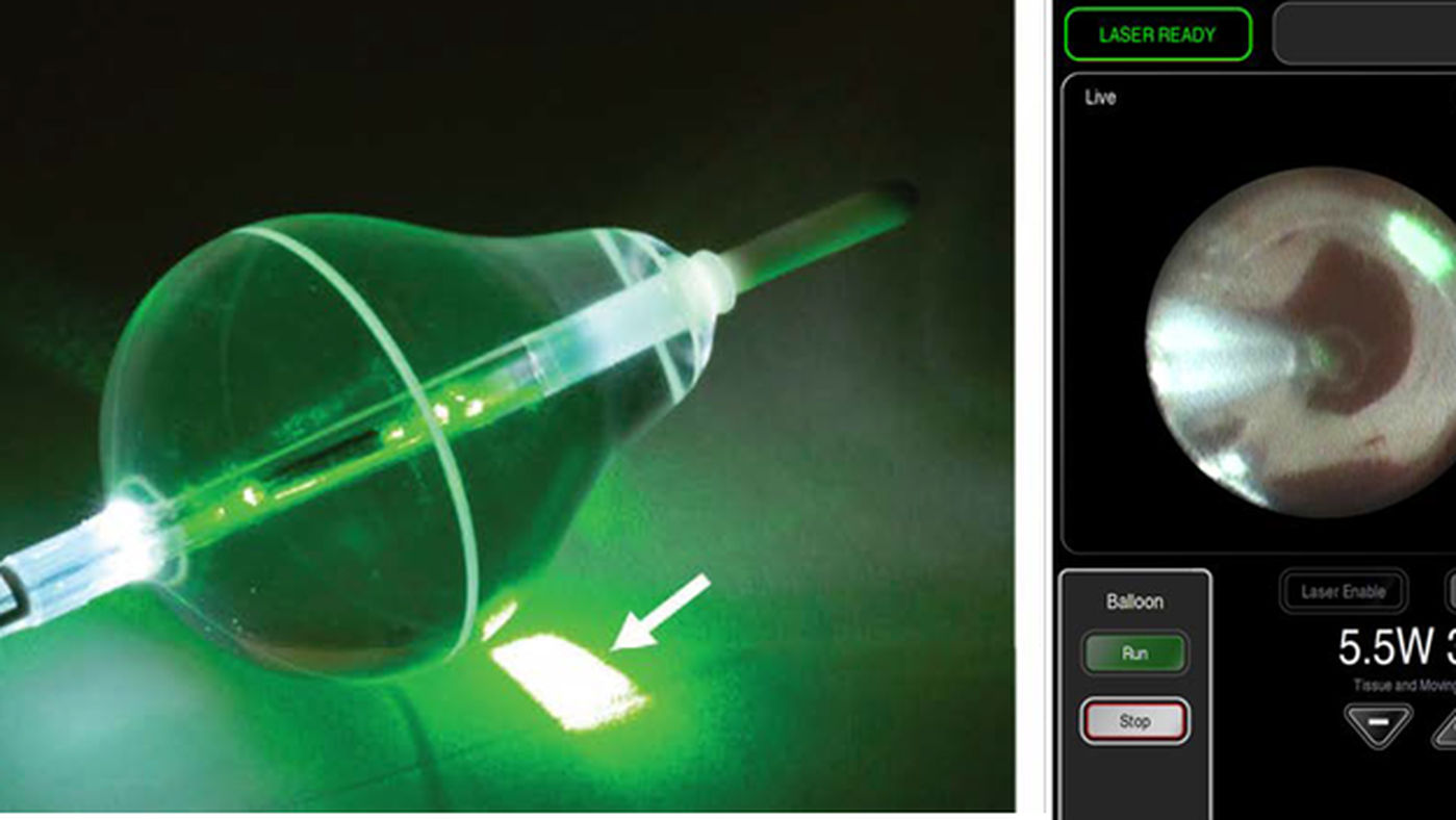 L'ablation de fibrillation atriale par laser : une première en France